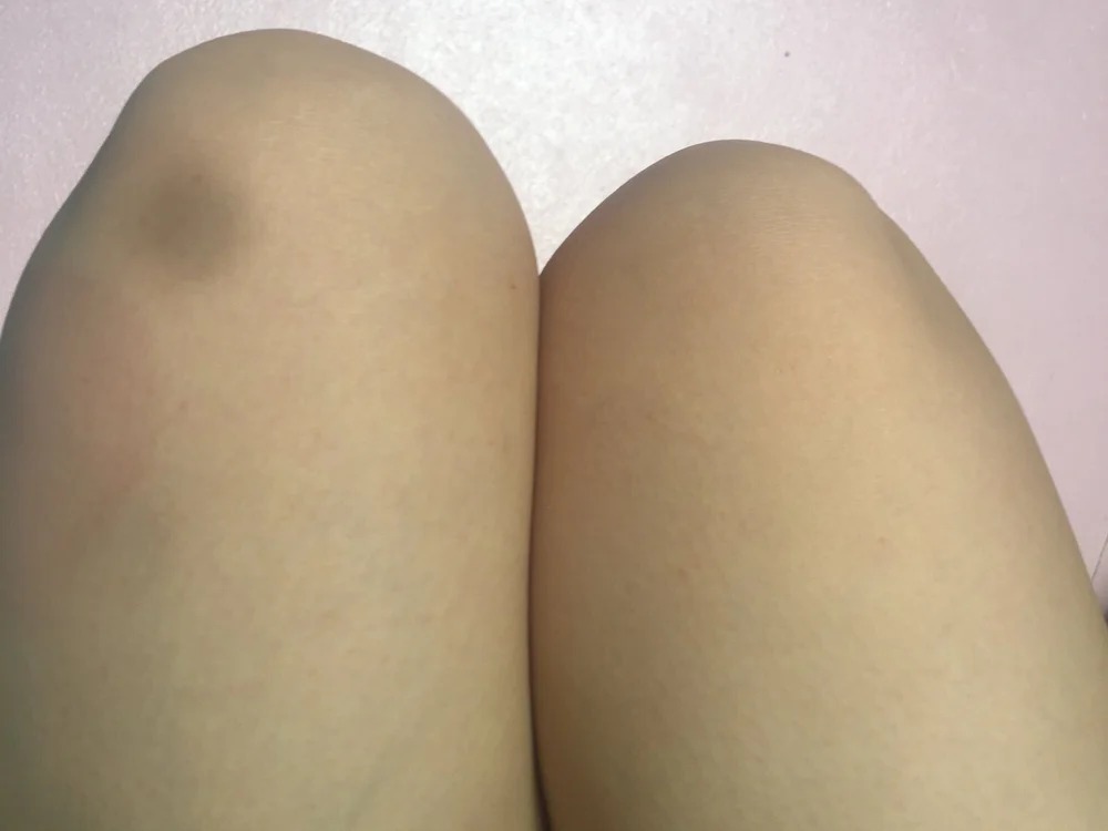 ngtra2
